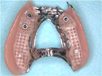 Partial dentures example