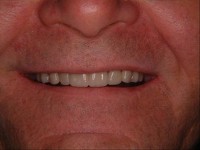 Implant dentures example
