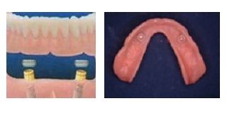 How implant dentures work