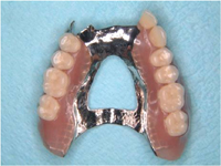 Partial dentures example